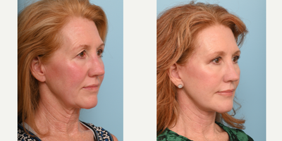 55-64 year old woman treated with Facial Fat Transfer - The doctorperformed an Extended Deep Plane Face & Neck Lift with Fat Transfer, Temporal Browlift & Upper Blepharoplasty 3 months ago to give her a naturally refreshed look.