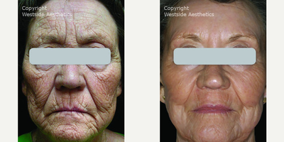 Woman treated with Active FX - This elderly, female patient was at a point in her life where she was obviously aging, but she still wanted to improve the look of her face. Overall she had many deep lines and wrinkles on her entire face from forehead to chin. She wasnt sure if a non-surgical option would give her the improvement she was looking for. She was introduced to Active FX, a CO2 laser for deep skin resurfacing. She decided to go forward with the treatment and took the necessary steps to prepare. After her procedure and a few weeks of recovery there was marked improvement in the texture, tone, volume and overall appearance of her skin.