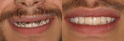 Direct Composite Resin Veneers - 
	When working with a recovering Meth user the dentist must get creative. Direct composite resin veneers were individually done by hand. The shape, shade, characteristics, function and esthetics were created directly in the mouth entirely by the hand of the Dr.. This method was chosen over a laboratory processed porcelain veneer because composite resin can be repaired and refreshed as needed should the need arise. With porcelain you would need to start all over.
