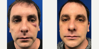 35-44 year old woman treated with Venus Viva - Excision in combination with Venus Viva laser treatment to eliminate this man's cyst on his face.