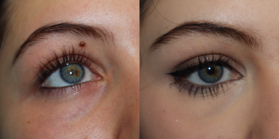 18-year-old woman treated with Mole Removal - Excision of upper eyelid mole