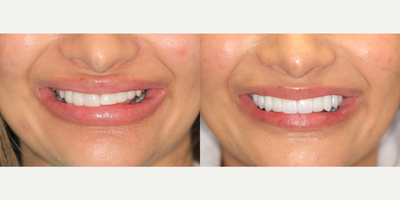 35-44 year old woman treated with Porcelain Veneers and BriteSmile - Opened bite with 4 back crowns and refreshed old bridges with new length color and symmetry
