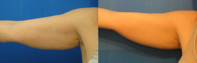 TriPollar - 
	Arms skin tightening after 5 treatments. 2 cm reduction. Photos supplied by manufacturer, Pollogen Ltd, All Rights Reserved.
