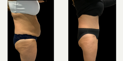 45-54 year old woman treated with Tummy Tuck - Abdominoplasty result