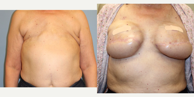 45-54 year old woman treated with Breast Reconstruction with Latissimus Flaps and Tissue Expanders - This patient presents 5 years following bilateral mastectomies and radiation. She opted to undergo a staged reconstruction using tissue from her back (latissimus flaps) and tissue expanders. Tissue expanders have been gradually filled with saline to the desired size. she will undergo exchange of bilateral tissue expanders and implant placement for her final results.