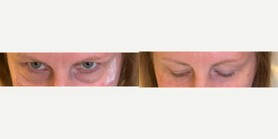 45-54 year old woman treated with Redensity 2 to tear troughs - Patient troubled with volume loss to tear troughs, excellent mid face volume and few rhytids made more prominent. Excellent result with cannula