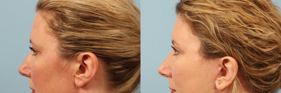 43 year old woman treated with Eyelid Surgery - 43 year old woman treated with Eyelid Surgery