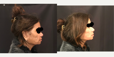 45-54 year old woman treated with Thread Lift - Nova PDO thread lift for mid-lower face