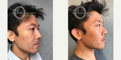 35-44 year old man treated with Facial Fat Transfer - fat transfer to cheek and lower eyelid surgery