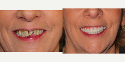 All-on-4 Dental Implants - All-on-4 Dental Implants