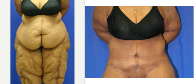 Body Lift  (front view) - Body Lift