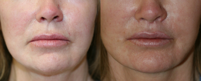 Lip Lift and Corner Lift - 
	Before and several months after lip surgery to rejuvenate aging facial expression
