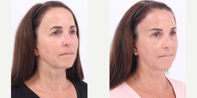 55-64 year old woman treated with Brow Lift, Eyelid Surgery - 58 year old patient is 3 weeks post Brow Lift and Upper Blepharoplasty.