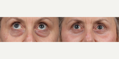 Woman treated with Deep Plane Facelift, Neck Lift, Eyelid Surgery, Facial Fat Transfer - Stunning transformations with Dr. Marotta at Marotta MDOur patient achieved remarkable results with:.- Deep Plane Face & Neck Lift.- Lower Blepharoplasty.- Fat TransferDr. Marottas personalized approach and expert guidance ensure patients feel supported and empowered from consultation to post-care, making their aesthetic dreams a reality with confidence.
