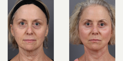 Woman treated with Deep Plane Facelift, Neck Lift, Eyelid Surgery, Facial Fat Transfer - Stunning transformations with Dr. Marotta at Marotta MDOur patient achieved remarkable results with:.- Deep Plane Face & Neck Lift.- Lower Blepharoplasty.- Fat TransferDr. Marottas personalized approach and expert guidance ensure patients feel supported and empowered from consultation to post-care, making their aesthetic dreams a reality with confidence.