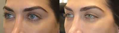 Young Woman Underwent Almond Eye Or Cat Eye Surgery With Natural Results - Young beautiful woman, who desired more cat eyes or almond shaped eyes, underwent lower eyelid retraction surgery with canthoplasty to achieve the desired effect with natural results.