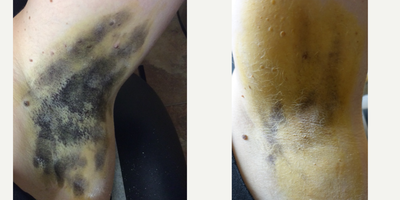 35-44 year old man treated with miraDry - Patient shown before and 2 weeks after mirDry treatment. An iodine solution is applied to the skin and allowed to air-dry. Once dry the area is dusted with cornstarch When sweat reaches the surface of the skin the starch and iodine combine causing a dramatic color change (yellow -&gt; dark blue) allowing sweat production to be actively visualized.
