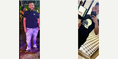 Man treated with Gastric Sleeve Surgery - Man treated with Gastric Sleeve Surgery.