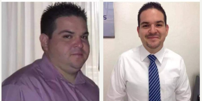 Man treated with Gastric Sleeve Surgery - Man treated with Gastric Sleeve Surgery.