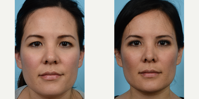 35-44 year old woman treated with Forehead Lift and Upper Blepharoplasty - Patient had hooding issues and it was getting worse over time.