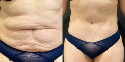 35-44 year old woman treated with Body Lift, Butt Lift, Diastasis Recti Repair, Liposuction, Mommy Makeover, Tummy Tuck - 37 year-old woman after three pregnancies with circumferential body lift that included tummy tuck with muscle repair and liposuction of the back and flanks