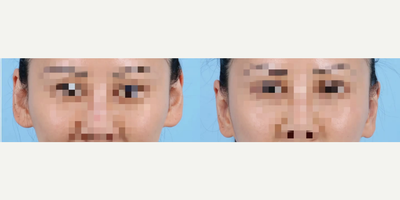 Woman treated with Ear Surgery - Woman treated with Ear Surgery