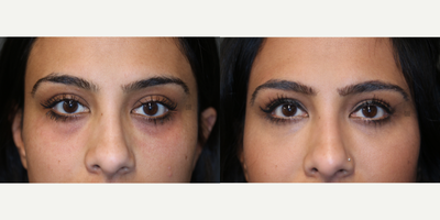 Microstructural Tear Trough FIller - Cannula used to add microstructural volume to improve bags and dark circles.