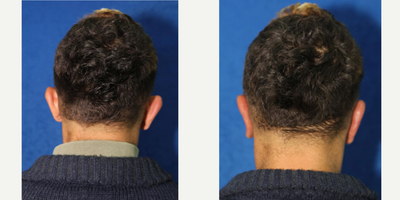 Otoplasty for Protruding Ears  (back view) - Otoplasty for Protruding Ears