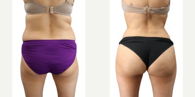Woman treated with Brazilian Butt Lift - Woman treated with Brazilian Butt Lift