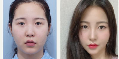 25-34 year old woman treated with Cheekbone Reduction, Double Eyelid Surgery, Jaw Reduction, Asian Rhinoplasty - Double Eyelid Surgery (Revision)- Epicanthoplasty (Revision)- Lower HotzFacial Contouring 3 Combination (ZAC)Rhinoplasty - Hump Removal- Osteotomy