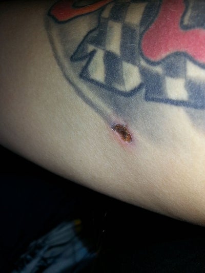 Laser Hair Removal on a Tattoo? (photo) Doctor Answers, Tips