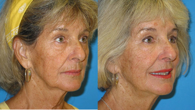 74 Year old woman treated for loss of facial volume with Sculptra - This 74 year old woman sought non surgical treatment to address the aging changes in her face. The photos shown are 4 weeks after three treatment sessions with Sculptra, for a total of 6 vials.