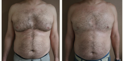 35-44 year old man treated with Liposuction - Chest Liposuction with Renuvion J plasma skin tightening