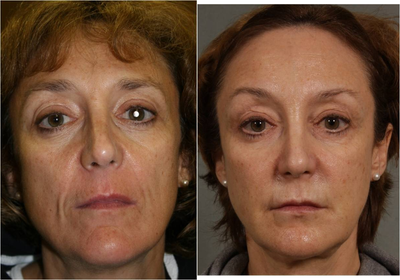60 Year old female 3 years after Sculpra treatments - 
	Before: Age 53. Note loss of facial volume, sunken appearance of lower lids and cheeks, jowls with squaring off of jaw line compared to the more youthful fullness she had in her 30's (see wedding photo) After: Age 60. Effects of Botox on brow elevation and frown lines. 3 Years after 3 Sculptra treatments (5 Vials total). Note how 7 years later, the patient appears 10 years younger due to filling in of areas of volume loss around her temples, cheeks, eyes, and jaw line. Patient has more of a heart shaped face vs. the more squared off appearance prior to treatments. Sculptra volume restoration has also made her face more gravity proof and slowed down sagging of her neck and jaw line.
