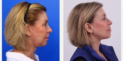 45-54 year old woman treated with Facelift, Neck Lift, Facial Fat Transfer, CO2 Laser - 54 year old 10 months after Facelift, Neck lift, Facial fat transfer and co2 laser
