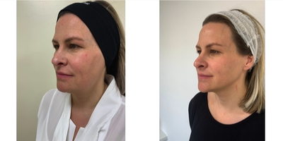 35-44 year old woman treated with Silhouette Soft - Before and after 6 silhouette soft thread lift (photos taken 2 weeks apart)