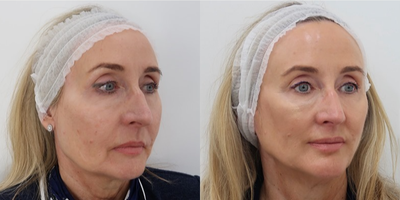 55-64 year old woman treated with Silhouette Soft - Before and after 8 silhouette soft thread lift (photos taken 2 weeks apart)