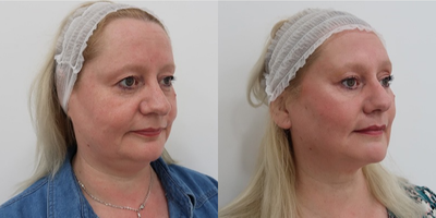 45-54 year old woman treated with Silhouette Soft - Before and after 10 Silhouette soft thread lift (photos taken 2 weeks apart)