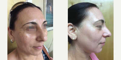 45-54 year old woman treated with IPL - IPL (Intense Pulse Light) Treatment with ZO Hydroquinone System