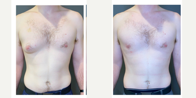 25-34 year old man treated with Gynecomastia Surgery, Breast Reduction - 25 year old man who suffered from one sided gynecomastia underwent right chest liposuction and excision of breast tissue for a masculine,  symmetric result. Pictured before and 3 months after. The scar is well hidden  around the areola.Hr- 5 10Wt- 175 lbs.