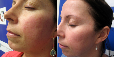 35-44 year old woman treated with IPL - IPL for rosacea after 6 treatments