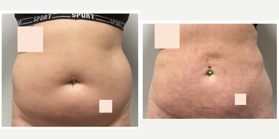 25-34 year old woman treated with Brazilian Butt Lift - 26 year old seeking improved contour of abdomen and enhancement of buttocks. She had liposuction 360 with fat transfer to buttocks.