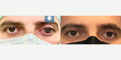 Man treated with Prosthetic Eye - It is a fact that prosthetic eye surgery makes a great contribution to the appearance of the person and makes them happy.