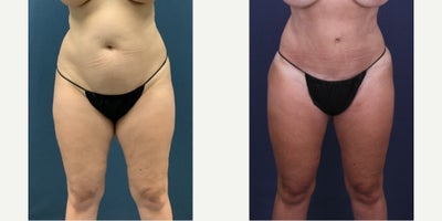 45-54 year old woman treated with Bella Body Lift with Butt Augmentation - 46-year-old female patient wants a smaller midsection. Here are her 1 year Bella Body Lift post-op results.