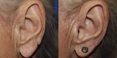 79-year-old woman treated with Earlobe Repair - Left bifid ear repair
