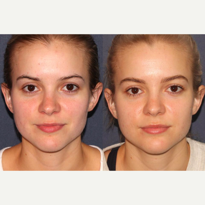25-34 year old woman treated with V Beam - Results from Dr. Groff performing one Vbeam Perfecta treatment on this patient who is in her late 20s and came in looking for a solution to her redness and broken capillaries! The after photo was taken just 6 weeks post treatment
