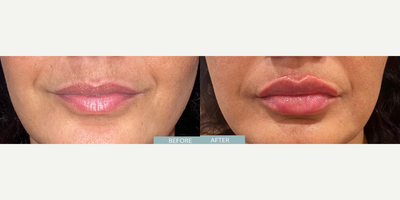 Woman treated with Lip Fillers - Woman treated with Lip Fillers