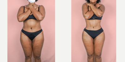25-34 year old woman treated with Liposuction, Brazilian Butt Lift - This patient had a prior tummy tuck but was unhappy with the contouring of her body and wanted improved shape around her torso and hips. She underwent a 360 Liposuction and Fat transfer and is shown 6 months after surgery.