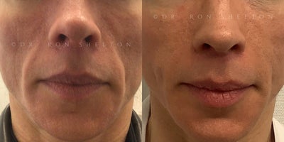 45-54 year old woman treated with Dermal Fillers, Nonsurgical Facelift - 48 year old woman treated with Evolysse Form one syringe