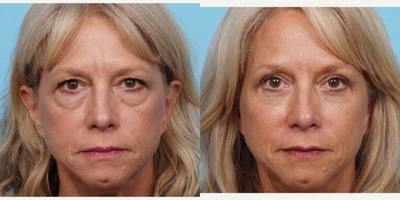 55-64 year old woman treated with Brow Lift - This patient had a trichophytic browlift and upper and lower eyelid surgery. By just treating around the eyes can give a wonderful effect of youthfulness of brightness of the face.